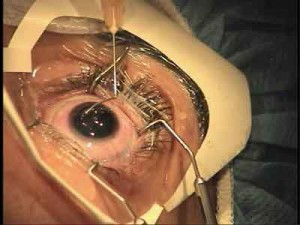 epi-lasik-2