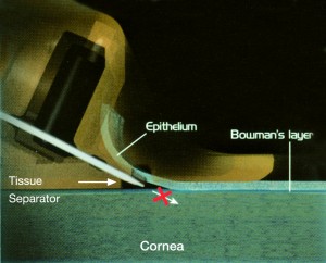 epi-lasik-3