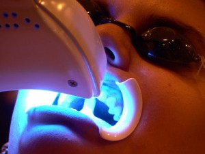 laser-teeth-whitening